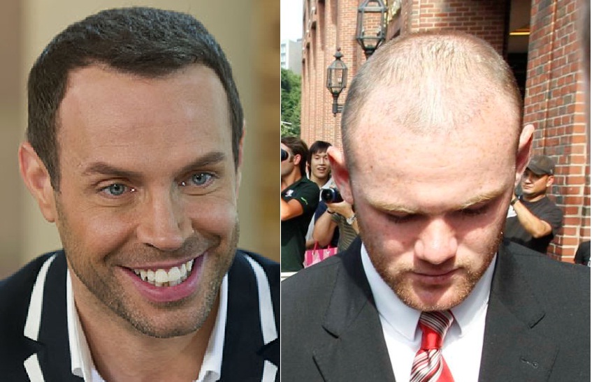 Celebrities With Hair Transplants  Skalptec  UK and Europe