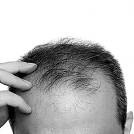 bad hair transplant