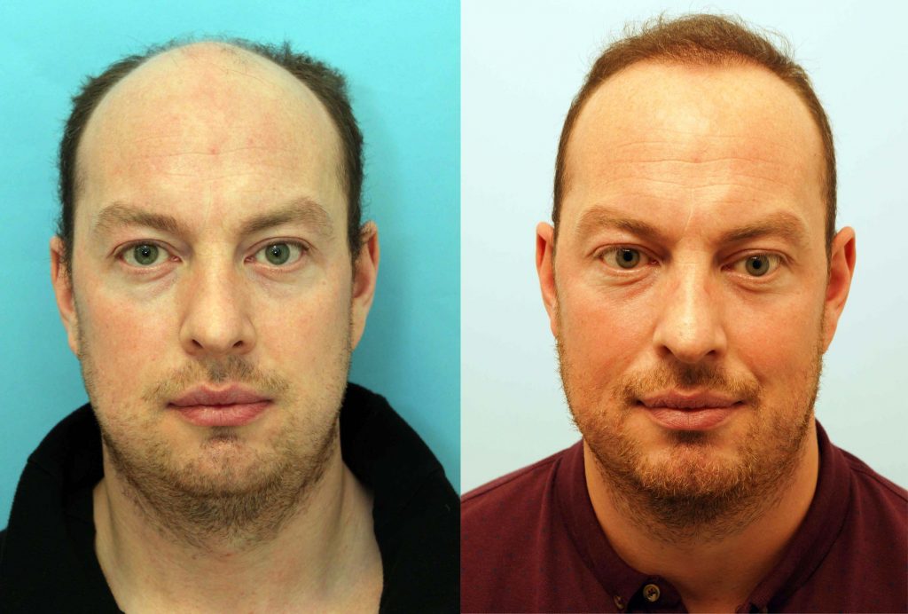 Harley Street Michael Pulman hair transplant with Farjo