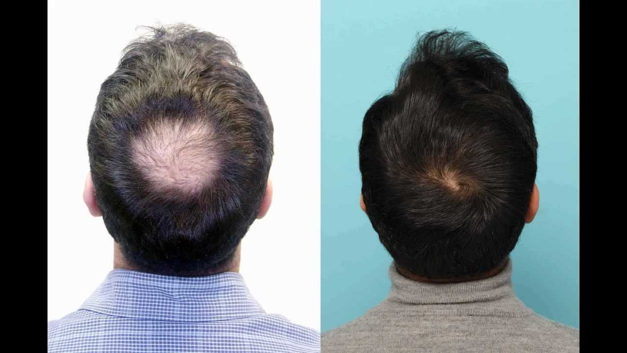 Malik from Leicester crown hair transplant result with intro by Dr Bessam  Farjo