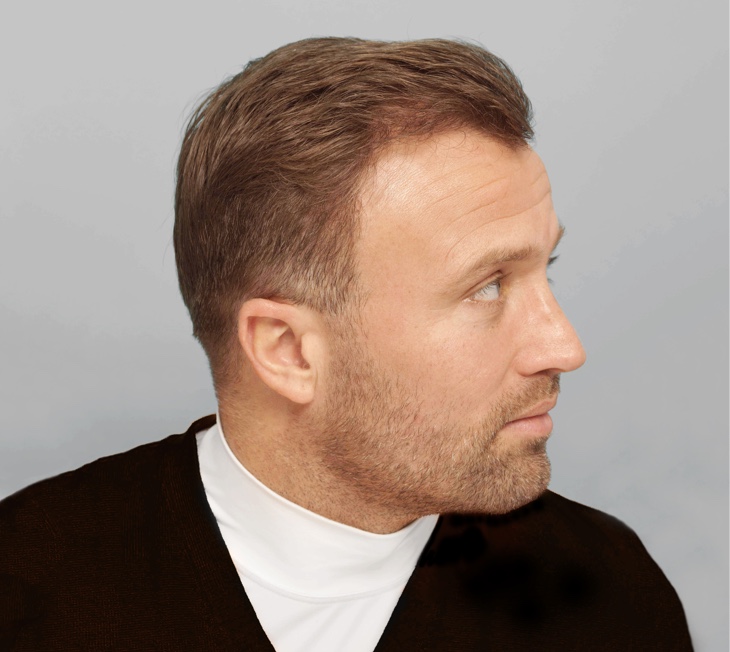Micky Gray Hair Transplant Results | Farjo Hair Institute Micky Gray Hair Transplant Results | Farjo Hair Institute