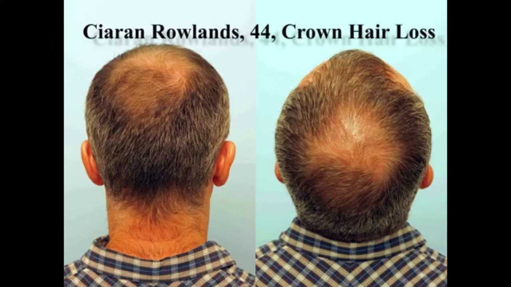 FUE Hair Transplant Result in the Crown: Ciaran Rowlands
