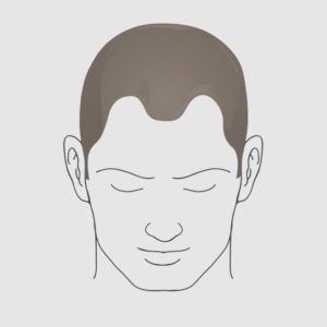 Type 2 hairloss