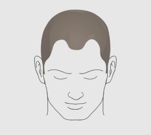 Type 2 hairloss