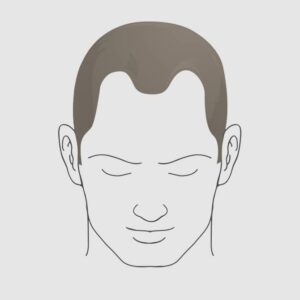 Type 3 hairloss