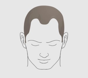 Type 3 hairloss