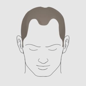Type 3 vertex hair loss