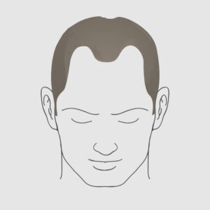Type 3 vertex hair loss
