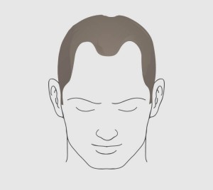 Type 3 vertex hair loss