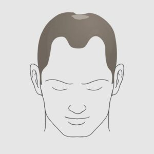 Type 4.2 hairloss