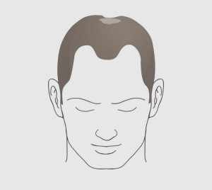 Type 4.2 hairloss