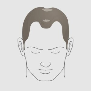 Type 5 hairloss