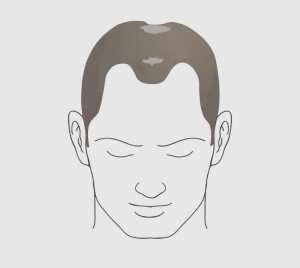 Type 5 hairloss
