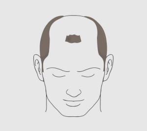 Type 6 hairloss