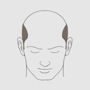 Type 7 hairloss