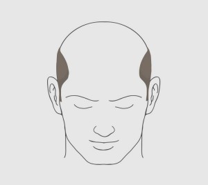 Type 7 hairloss