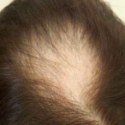 ALOPECIA AREATA