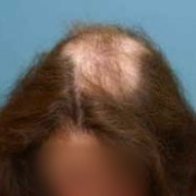 TRICHOTILLOMANIA