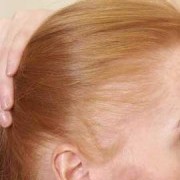 This is caused by tight braiding or pulling on the hair (e.g. tight ponytail hairstyle) and is temporary if the traction is short-term, but becomes permanent with prolonged pulling. One male example of this is seen in some Sikh men after years of tying up their long hair. It is most usually seen as a bald area at the very front of the hairline. Hair transplant surgery can restore hair permanently, as long as the cause of the problem ceases.