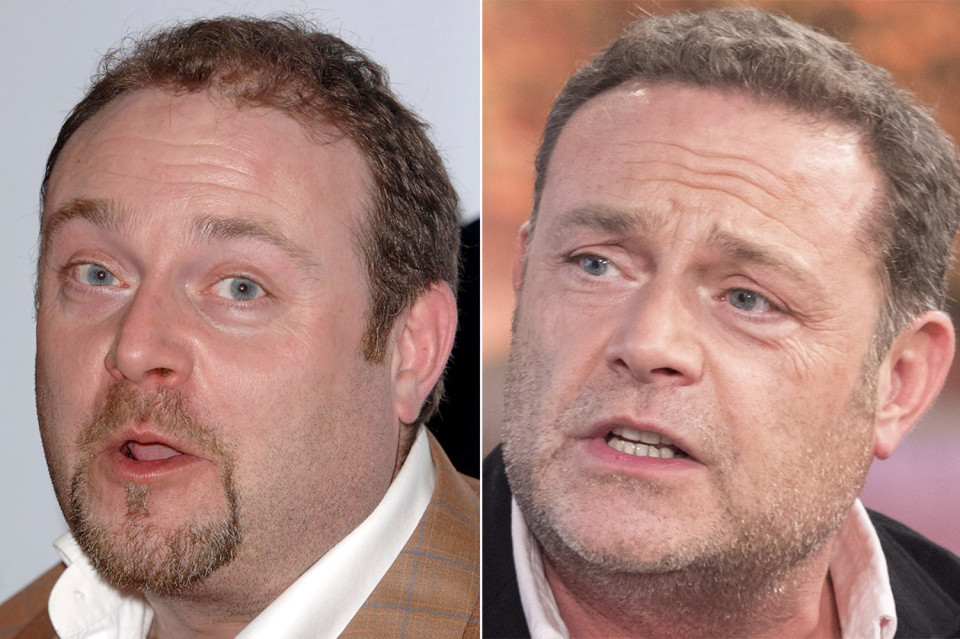 cold feet star John Thomson hair loss