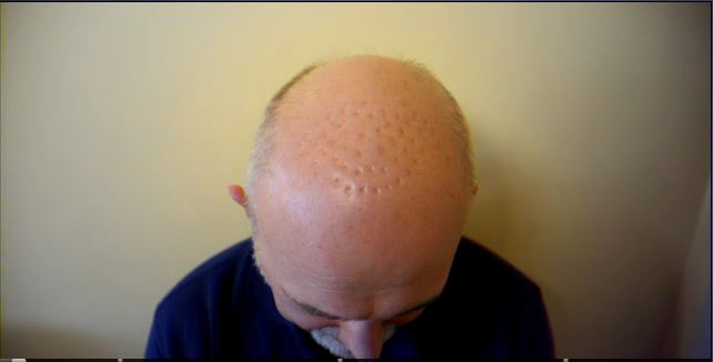 hair unplugged Botched Up Bodies (Credit Channel 5)