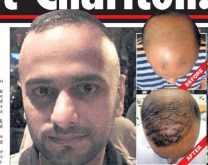 Cheap Hair Transplant