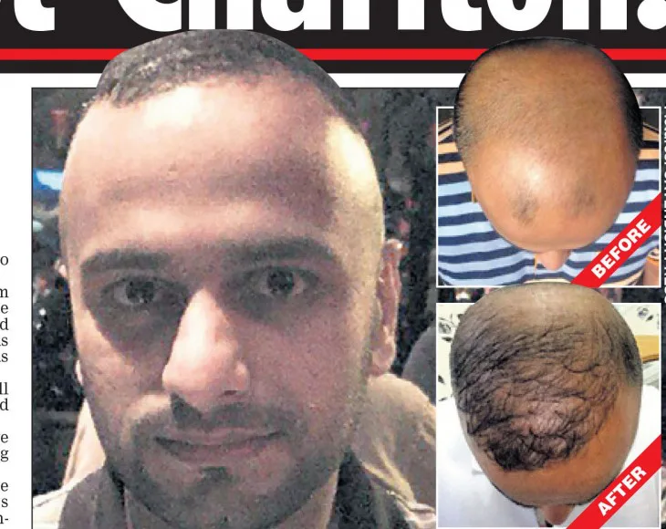 Considering A Cheap Hair Transplant? Think Again | Farjo Hair Institute Considering A Cheap Hair Transplant? Think Again | Farjo Hair Institute