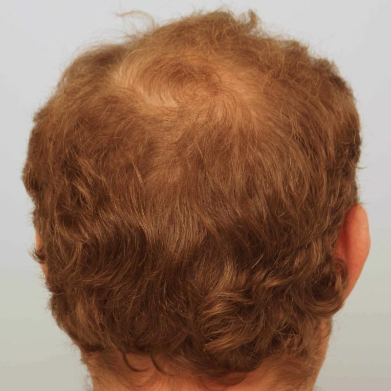 John Thomson Hair Transplant Results | Farjo Hair Institute