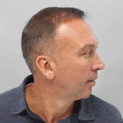 David Platt Hair Transplant Results | Farjo Hair Institute