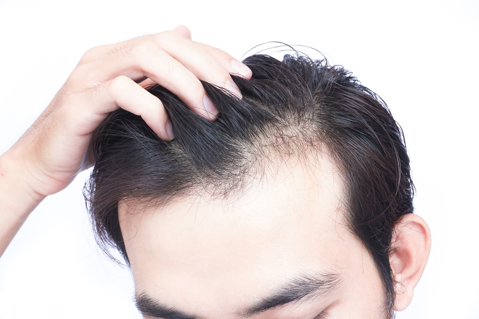 Волос на голове выпадают пучками. Выпадение волос у мужчин. Прически с облысением.