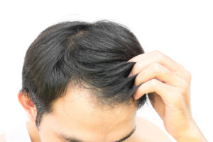 Recovering From Hair Transplant