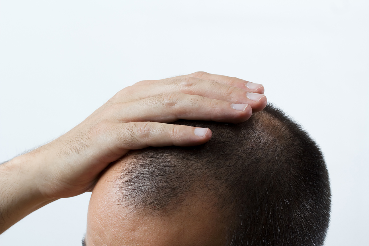 At what age should you get hair transplant?