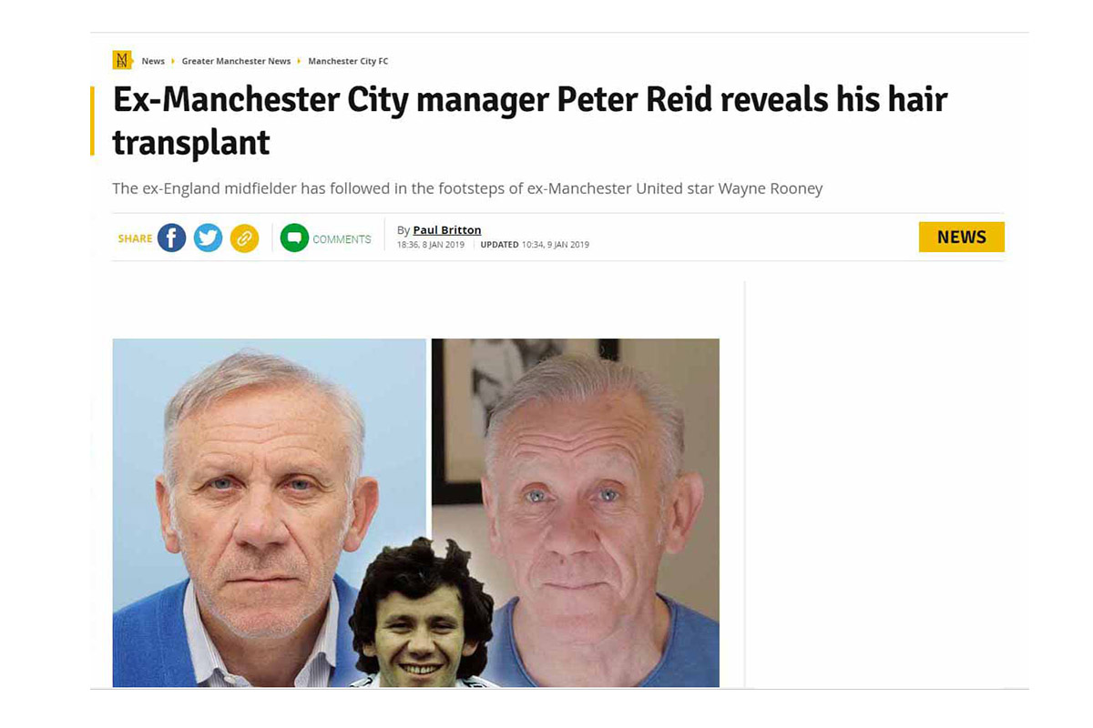 Ex-Manchester City manager Peter Reid reveals his hair transplant
