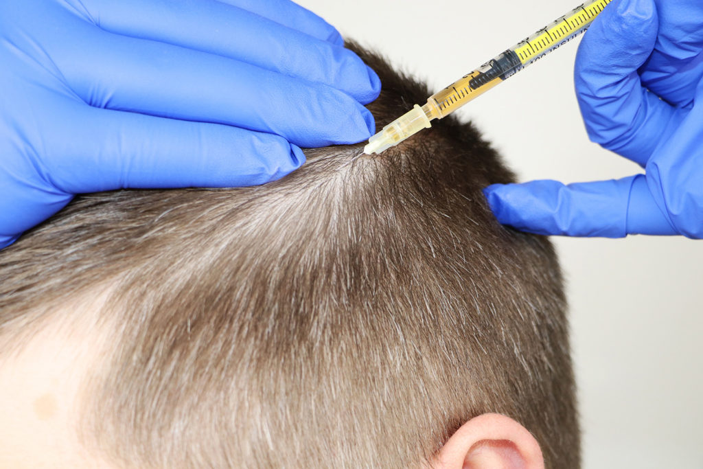 what to expect from your hair transplant