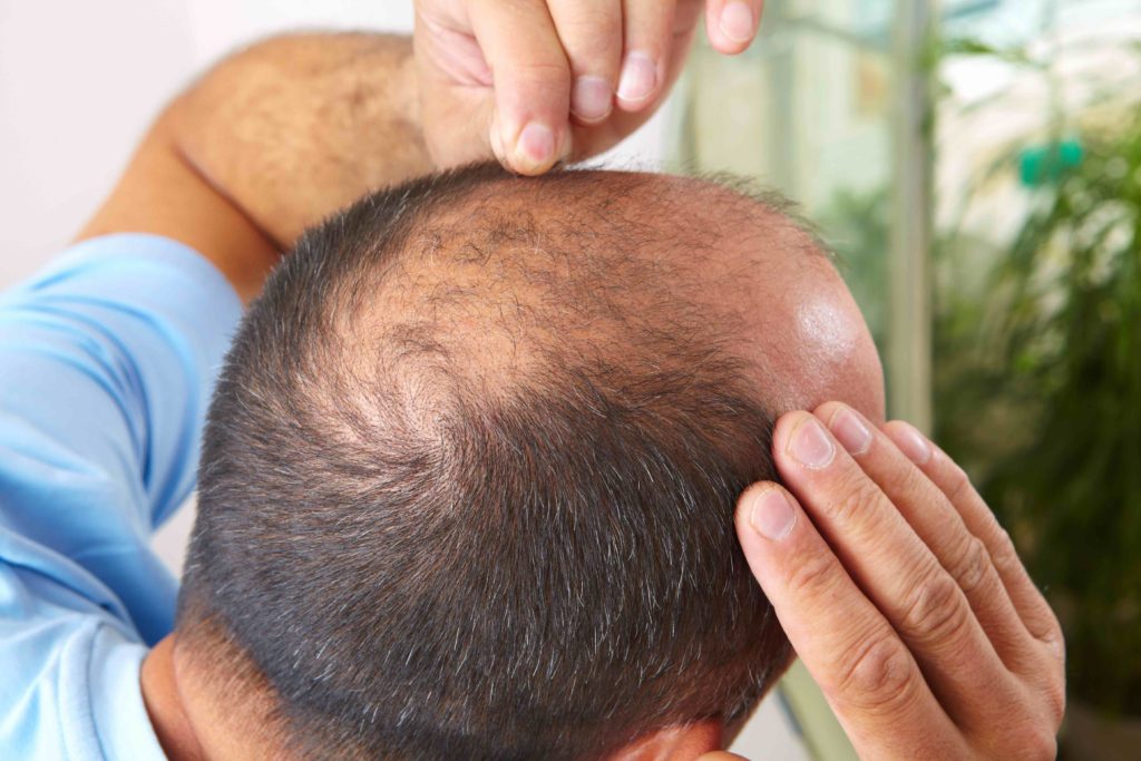 17 Best Hair Loss Treatments for Men in 2023