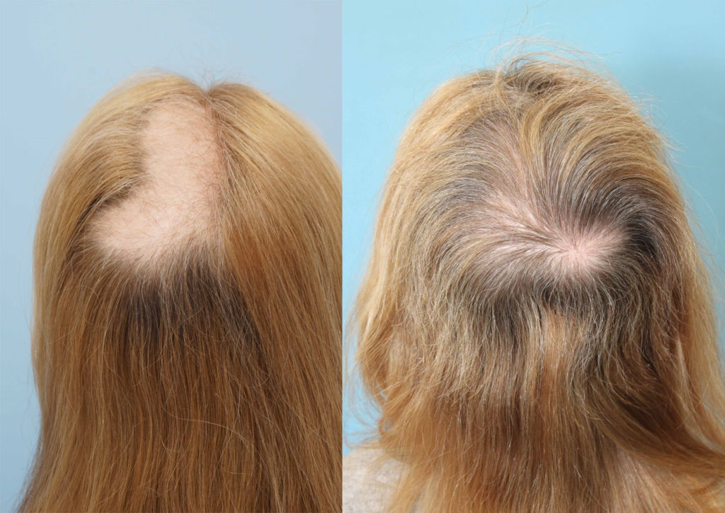 What is Trichotillomania  Hair Loss Clinic  PRP AAPE Laser Light  Therapy Men  Women