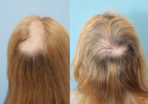 trichotillomania