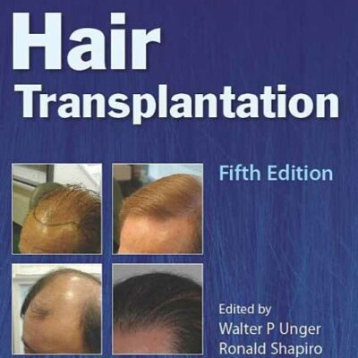 Hair Transplantation in Transgender Patients