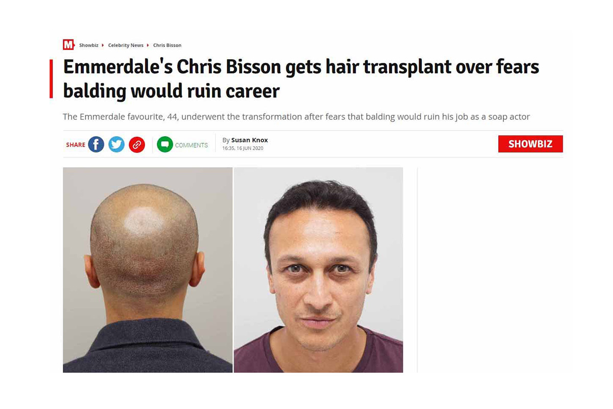 Emmerdale’s Chris Bisson gets hair transplant over fears balding would ruin career