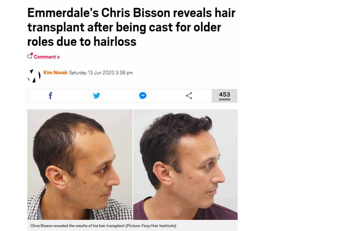 Emmerdale’s Chris Bisson reveals hair transplant after being cast for older roles due to hairloss