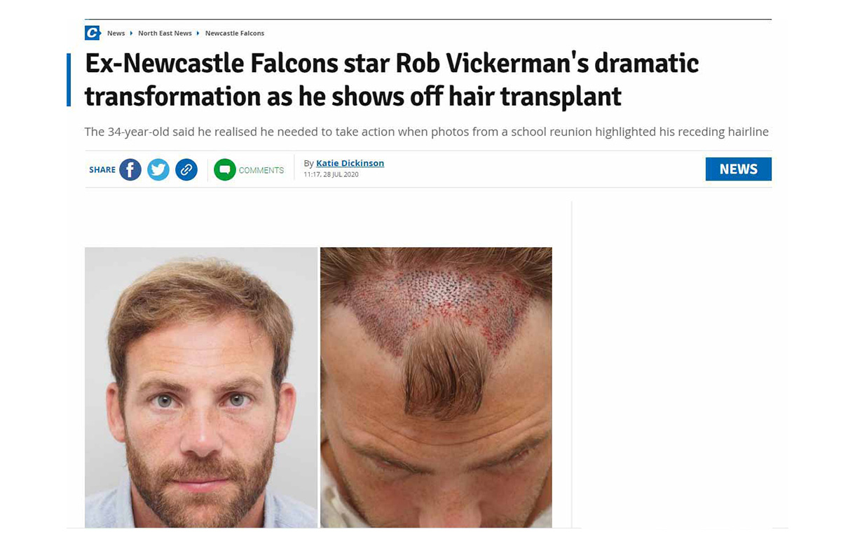 Ex-Newcastle Falcons star Rob Vickerman’s dramatic transformation as he shows off hair transplant