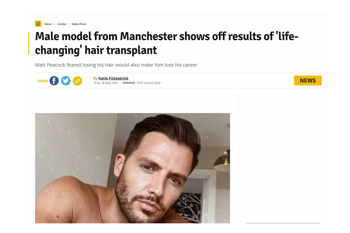 Male model from Manchester shows off results of ‘life-changing’ hair transplant