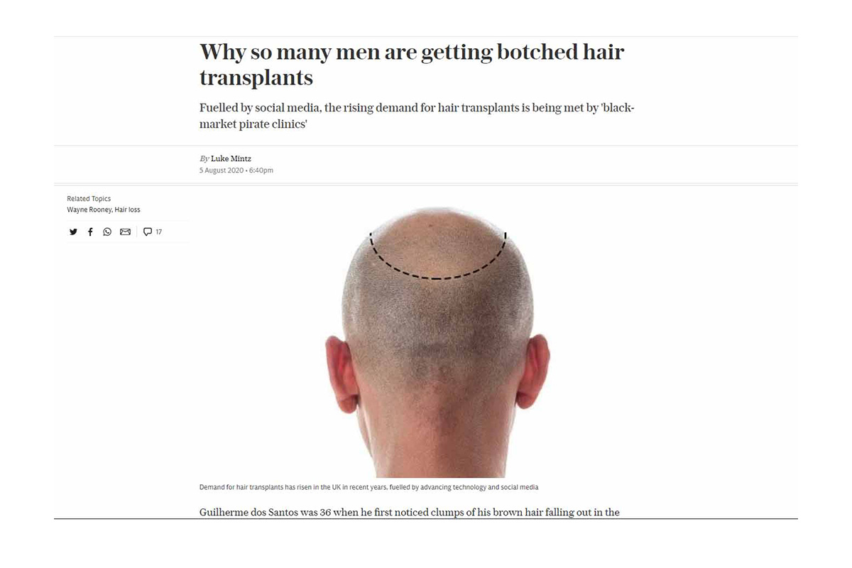 Why so many men are getting botched hair transplants