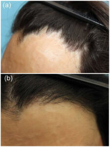burn scar alopecia examples