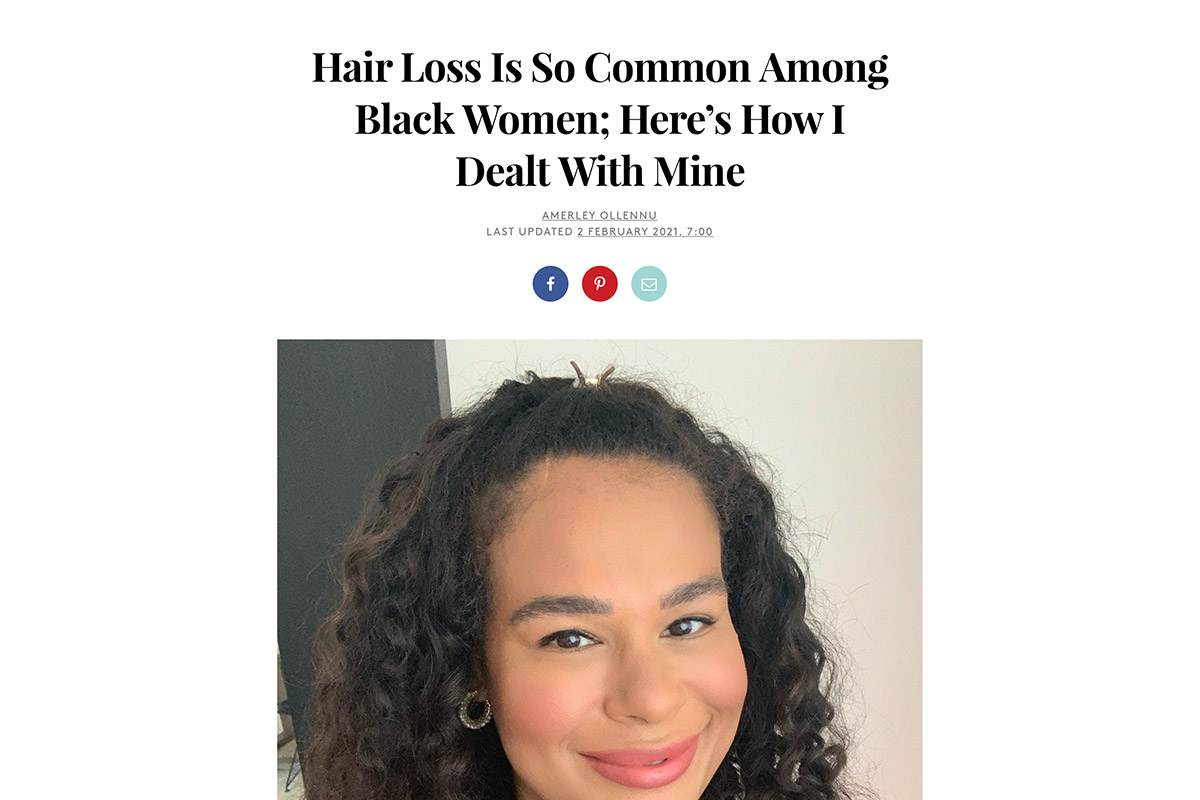 Hair loss is so common among black women; here’s how I dealt with mine