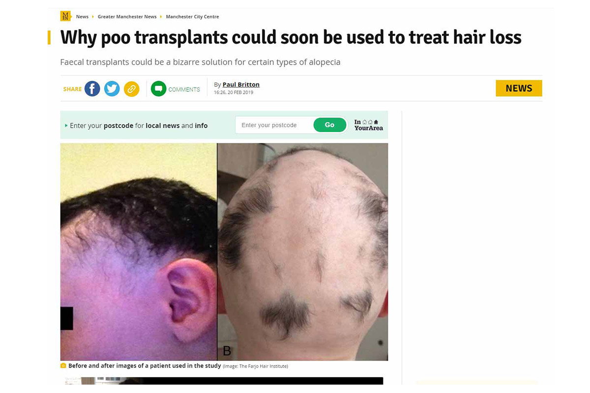 Why poo transplants could soon be used to treat hair loss