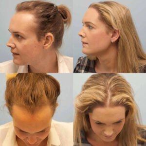 Transgender Hair Transplant Surgery