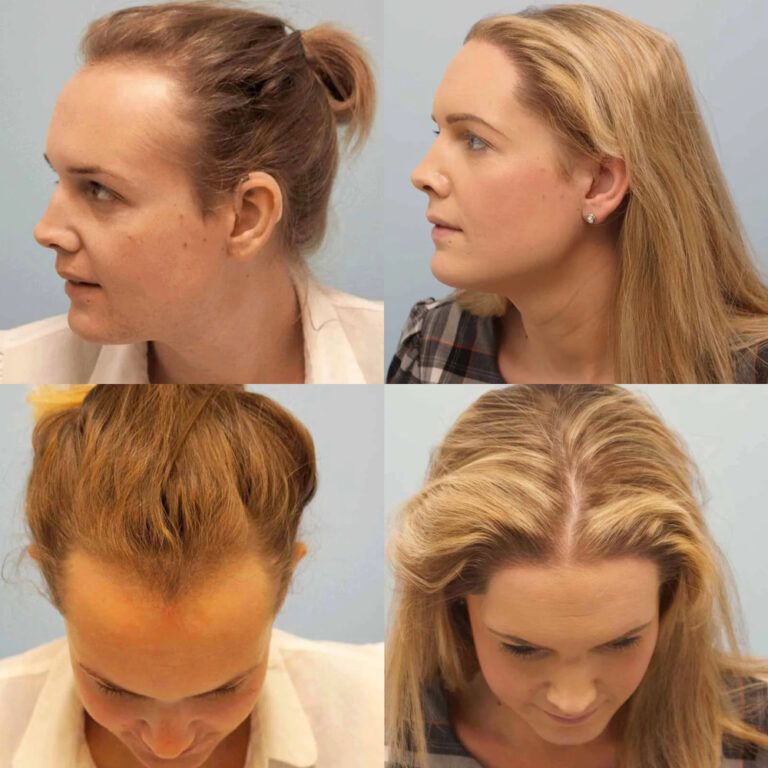 Transgender Hair Transplant Surgery Whats Involved