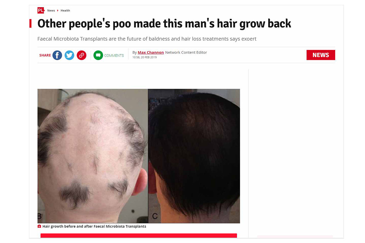 Other people’s poo made this man’s hair grow back