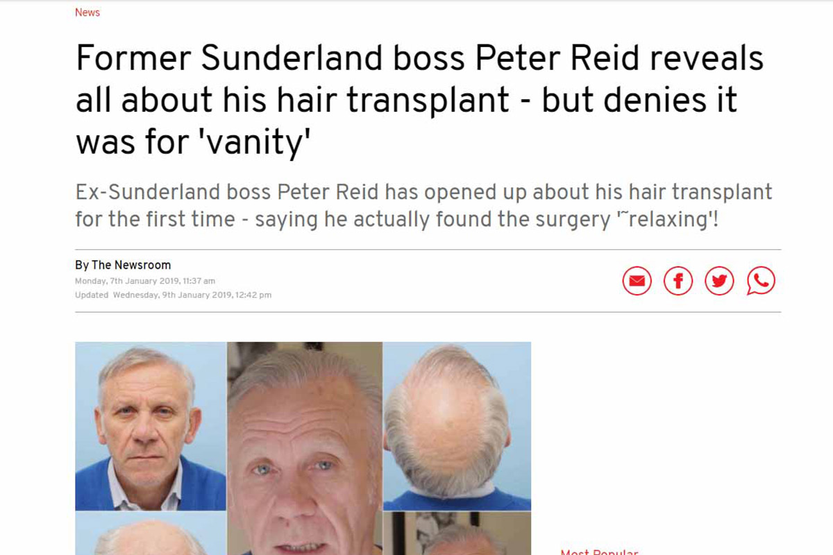 Former Sunderland boss Peter Reid reveals all about his hair transplant – but denies it was for ‘vanity’